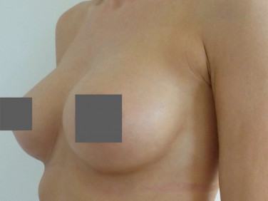 bruststraffung-stuttgart-mit-implantat-von-a-auf-c