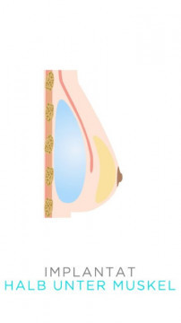 Darstellung eines Brustimplantats halb unter dem Muskel